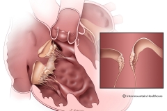 surgical repair of tricuspid valve