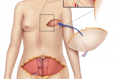 DIEP-flap