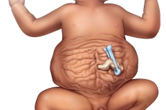 prune belly