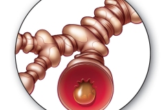 asthma-constriction