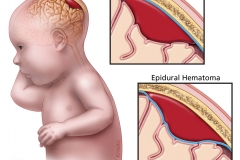 epidural and subdural hematomas