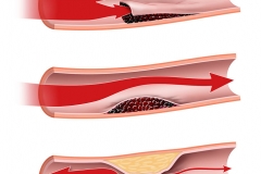 normal-SCAD-hematoma-atherosclerosis-blood-clot