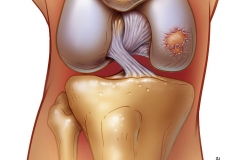 osteochondral defect in knee