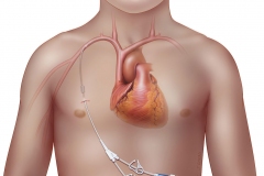 Tunneled central venous catheter