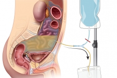 peritoneal dialysis-drain