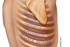 completed rib fracture surgery