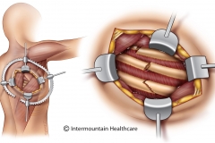 exposure for rib fracture surgery