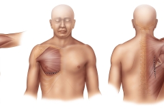 incisions-positions for rib fracture surgery