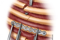 rib reduction-plate application-fractured ribs