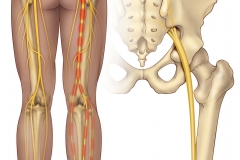 sciatica