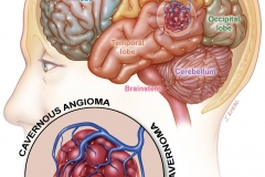 supratentorial cavernous angioma